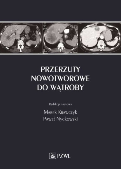 Группа авторов - Przerzuty nowotworowe do wątroby