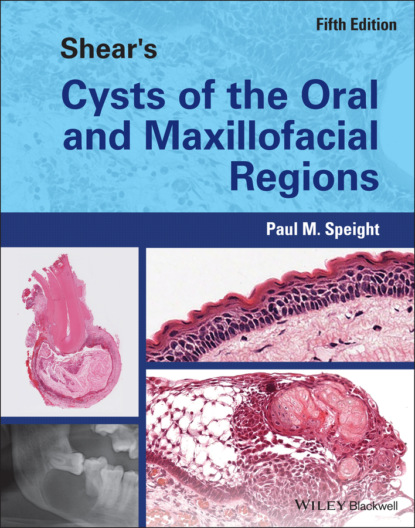 Shear s Cysts of the Oral and Maxillofacial Regions